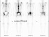 22 Bone Scan With Metastasis