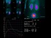 26 Mag 3 Obstructed Lt Kidney2