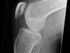 29 Bone Scan 2 Femur Lesion X Ray (1)